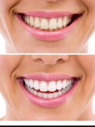 Brush Buddies Herbal Whitening Toothpaste w/ Activated Charcoal (1 set)
